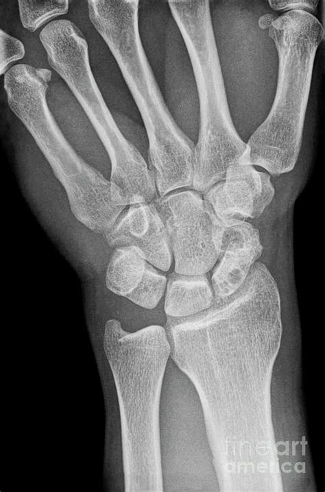 Fractured Scaphoid Wrist Bone Photograph by Science Photo Library - Pixels