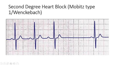 Heart Block Types Ecg