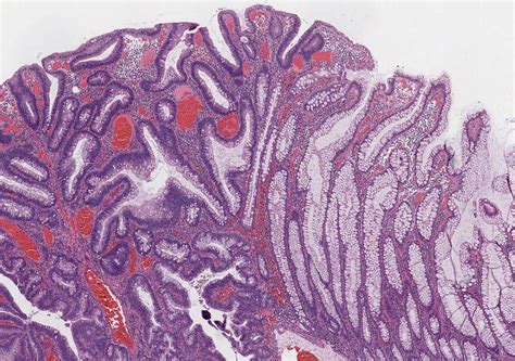 Tubular adenoma (colon and rectum) - MyPathologyReport.ca