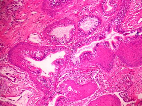 Pathology Outlines - Mucoepidermoid carcinoma