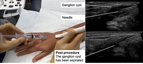 Ganglion cyst aspiration & steroid injection| Musculoskeletal ...