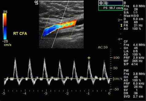 Arterial Doppler Ultrasound