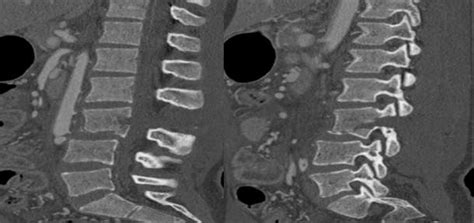 Sagittal lumbar CT-scan showing L3 fracture with anterior vertebral ...