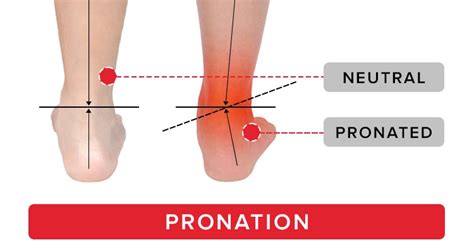 The Best Orthotics for Pronation | EasyFeet Blog – EASYFEET. Orthotic ...