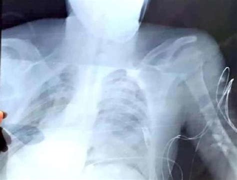 X-ray Clavicle Fracture. | Download Scientific Diagram