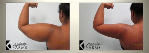 Arm Liposuction Before and After Results Large