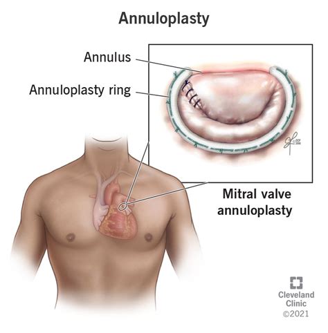 Annuloplasty: Valve Repair of the Heart