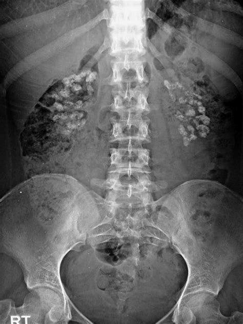 Medullary nephrocalcinosis - radRounds Radiology Network