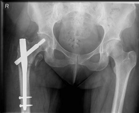 IBIMA Publishing Femoral Nerve Injury Due to an Open Subtrochanteric ...