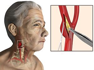 Carotid Endarterectomy Surgery Sydney | CAD Treatment Sydney