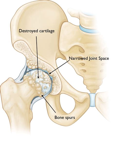 Hip Osteoarthritis - OrthoInfo - AAOS