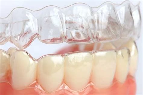 Teeth Aligners Over The Counter - TeethWalls