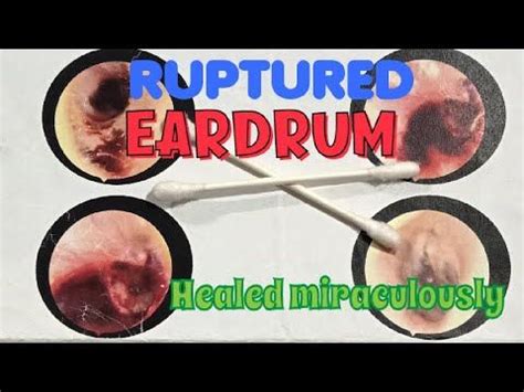 I ruptured my EARDRUM. Healed in 6 months without any surgery. Here's ...