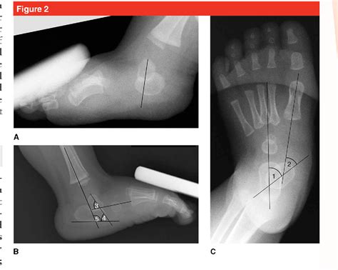 Figure 2 from Congenital Vertical Talus: Etiology and Management ...