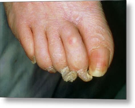 Toenails Showing Onychogryphosis Photograph by Medical Photo Nhs ...