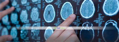 Meningioma Surgery - What You Need To Know? | MedicGlobus