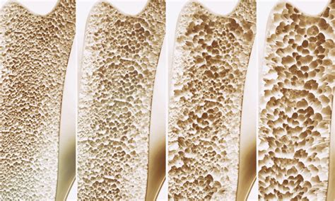 Osteoporosis treatments may benefit from discovery of key driver of low ...