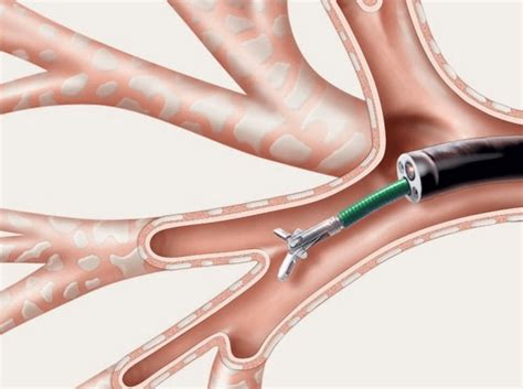 BRONCHOSCOPE - LUIS MIRAMONTES MEMORIAL FOUNDATION