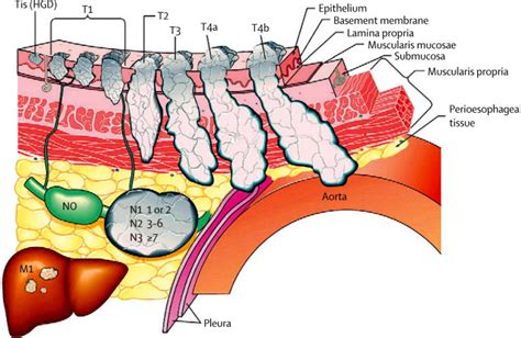 Oesophageal carcinoma - The Lancet