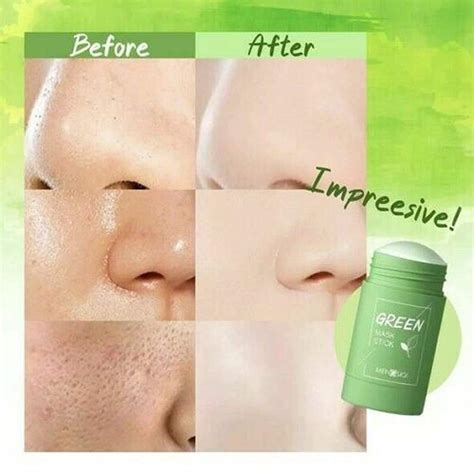 Face Mask For Acne | matnahanquoc