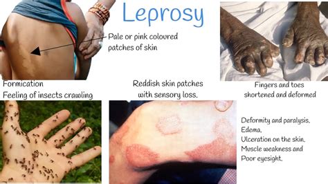 Leprosy: Causes, Transmission, Symptoms & Treatment - Public Health Notes