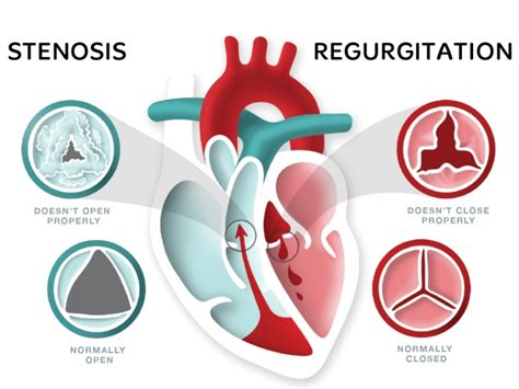 Heart Valve Disease – What does that mean?