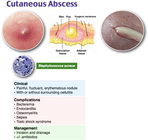 emDOCs.net – Emergency Medicine EducationEM@3AM: Abscess - emDOCs.net ...