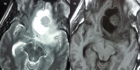 Dr Balaji Anvekar FRCR: Pilocytic Astrocytoma