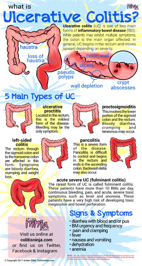 The Ins and Outs of Ulcerative Colitis | Colitis Ninja