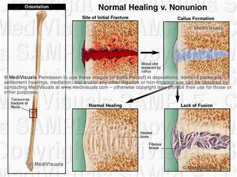 The Medical Legal Exhibit Expert Blog: Complications Associated with ...