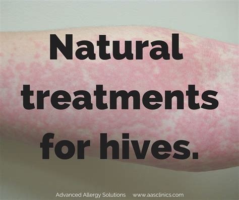 How to Treat Hives Naturally | Advanced Allergy Solutions®