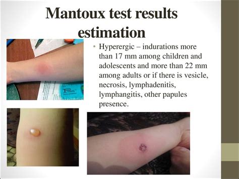 Mendel-mantoux-test - Captions Quotes