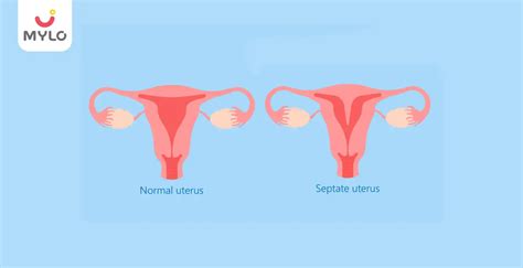 Septate Uterus: Symptoms, Risks and Treatment Options | MyloFamily