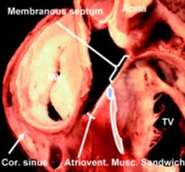 Development and structure of the atrial septum | Heart