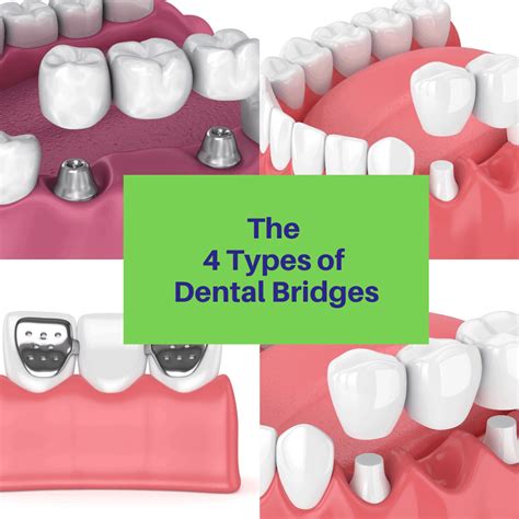 Types Of Dental Bridges - Best Image Viajeperu.org