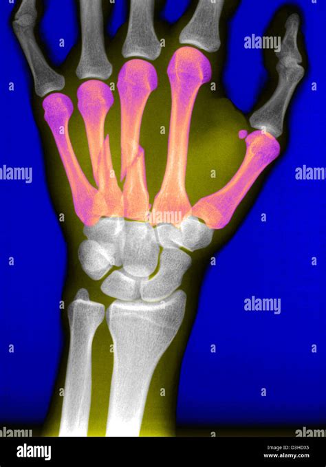 FRACTURED HAND, X-RAY Stock Photo - Alamy