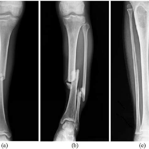 Xrays Of Broken Legs