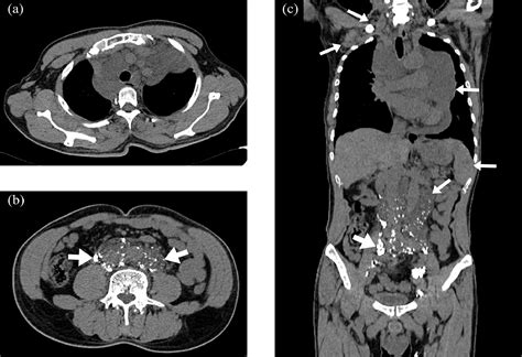 Diagnosis of Lymphangiomatosis: A Study Based on CT Lymphangiography ...