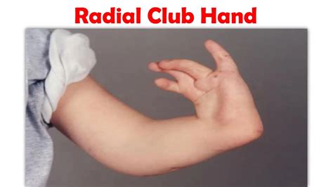 Radial club hand by Kids Orthopedic - Issuu