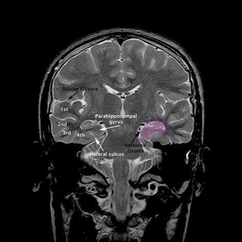 MRI Brain ambiens cistern anatomy | Radiology Anatomy Images | Mri ...