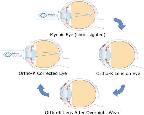 Orthokeratology (Ortho-K) | InFocus Optical