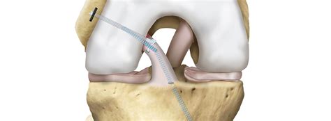 ACL repair augmented with the InternalBrace - a look at the 5-year ...