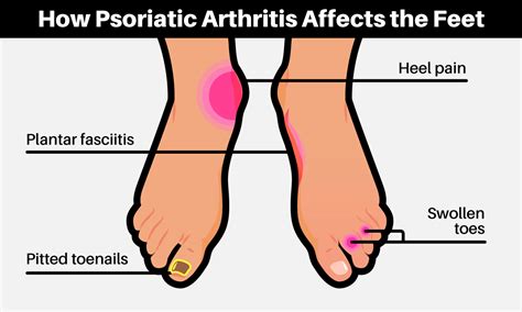 8 Ways To Manage Psoriatic Arthritis Foot Pain | MyPsoriasisTeam