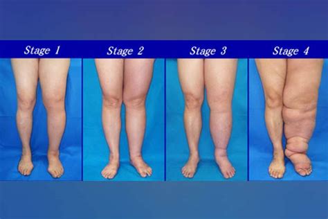 Elephantiasis - Symptoms, Causes, Complications & Treatment - Santripty