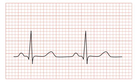 الکتروکاردیوگرام (ECG) چیست و به چه منظوری انجام می شود ؟ | کافه پزشکی ...