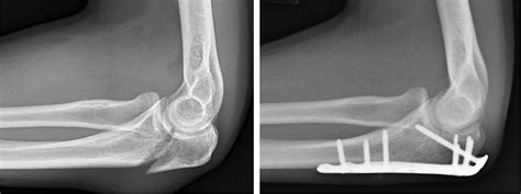 Olecranon Process Fracture