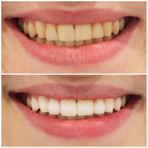 Teeth Whitening Brisbane [Free Consult] | Smiling Dental