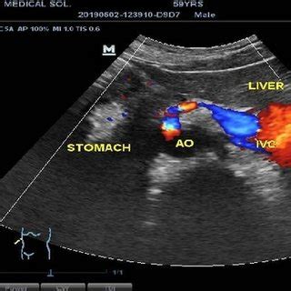 Ultrasound image of the epigastric region in longitudinal plane. This ...