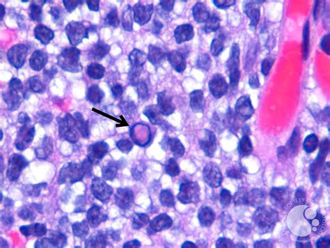 Dutcher Bodies in Lymphoplasmacytic Lymphoma 2