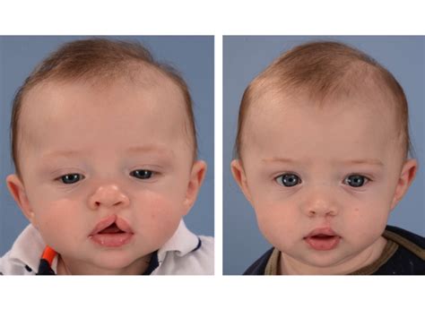 Cleft Lip Before and After Photos — Dallas Pediatric Plastic Surgeon ...